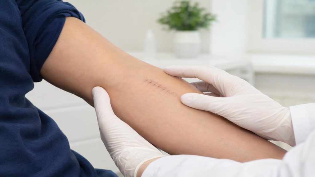The Complete Guide to the Healing Stages of Stitches: What to Expect Day by Day 2 infected stitches signs