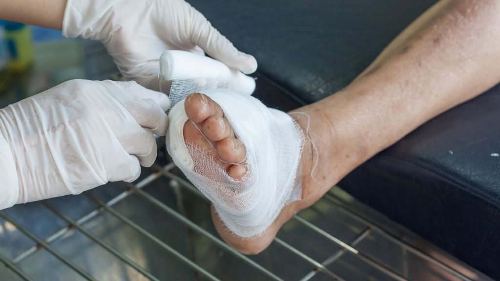 How Long Does a Diabetic Foot Ulcer Take to Heal? 1 diabetic foot wound healing